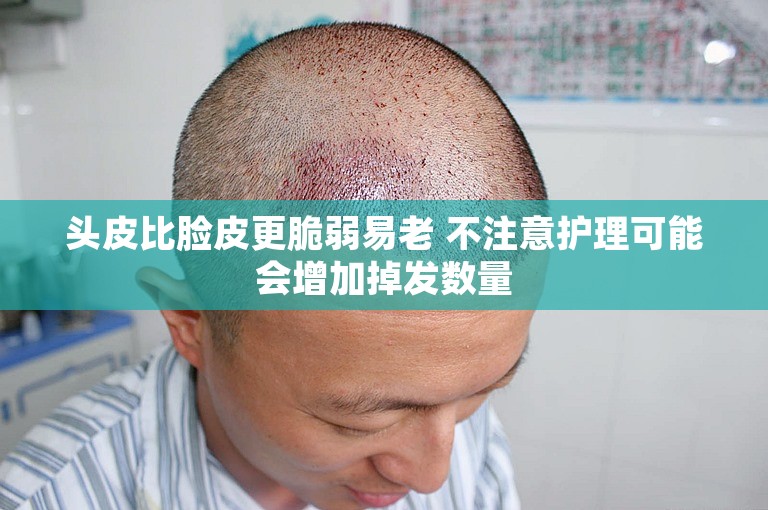 头皮比脸皮更脆弱易老 不注意护理可能会增加掉发数量