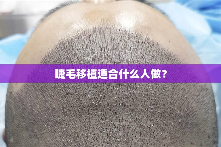 睫毛移植适合什么人做？