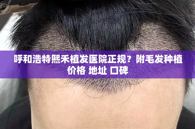 呼和浩特熙禾植发医院正规？附毛发种植价格 地址 口碑