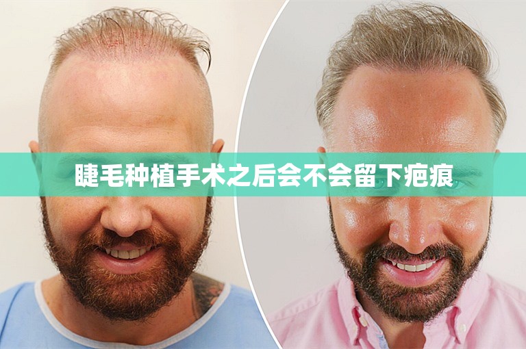睫毛种植手术之后会不会留下疤痕