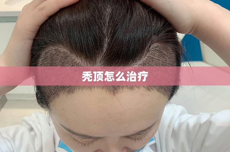秃顶怎么治疗