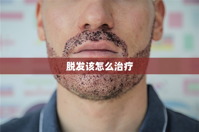 脱发该怎么治疗