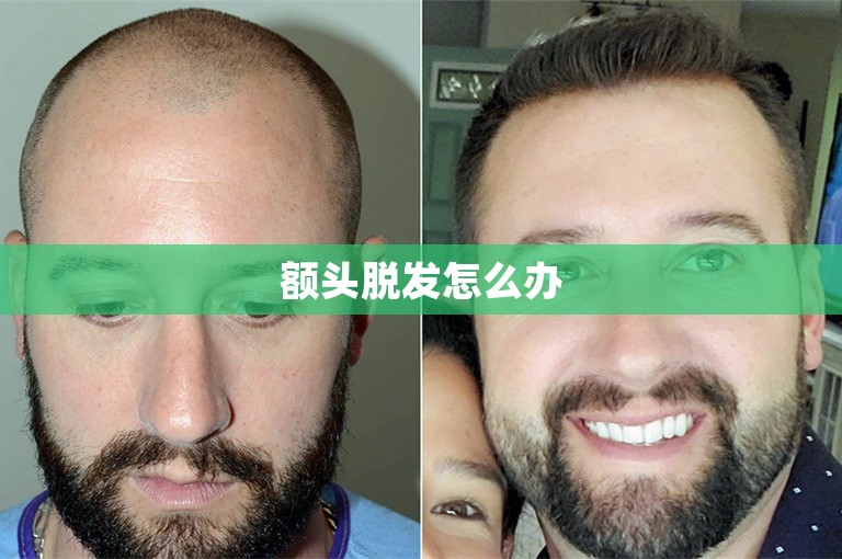 额头脱发怎么办