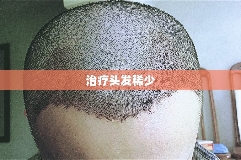 治疗头发稀少