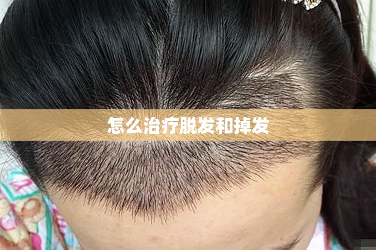 怎么治疗脱发和掉发