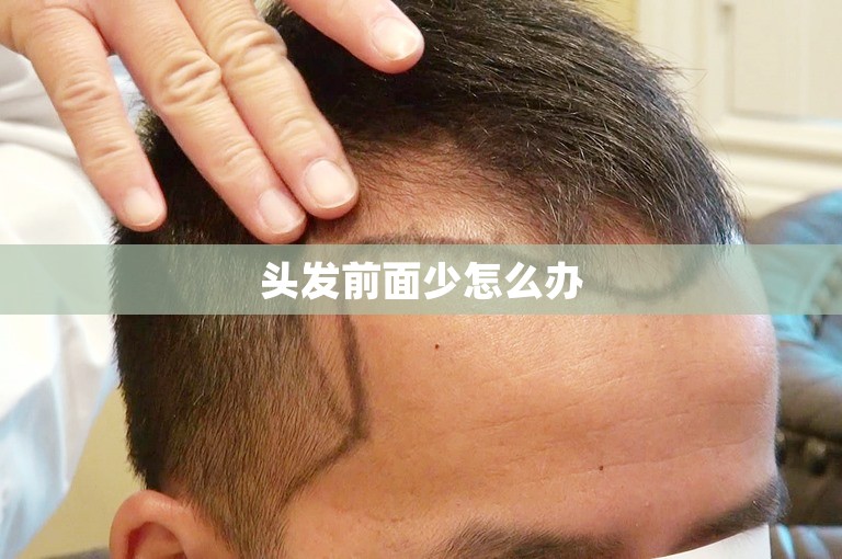 头发前面少怎么办