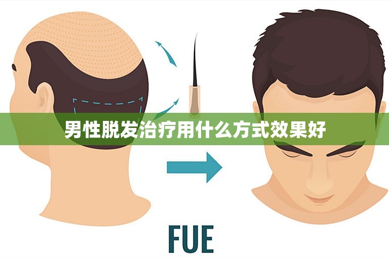 男性脱发治疗用什么方式效果好