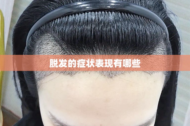 脱发的症状表现有哪些