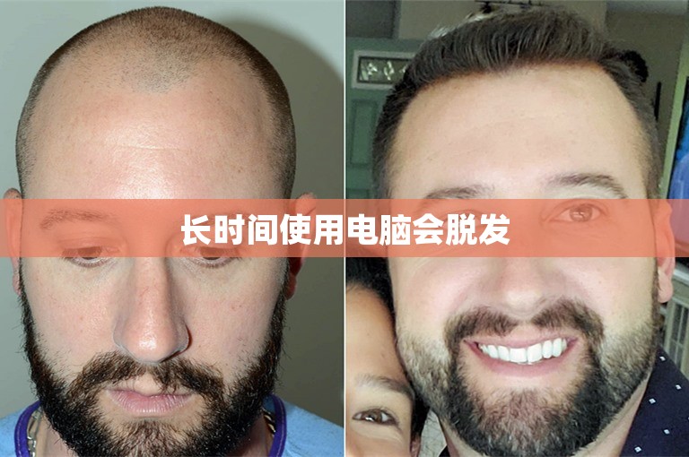 长时间使用电脑会脱发