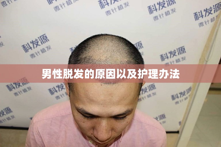 男性脱发的原因以及护理办法