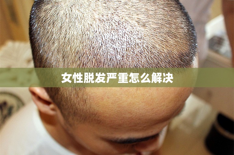 女性脱发严重怎么解决