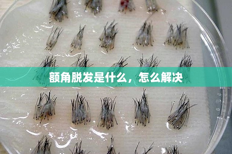 额角脱发是什么,怎么解决 额角脱发是什么,怎么解决