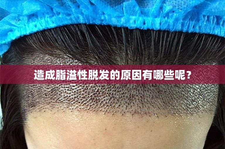 造成脂溢性脱发的原因有哪些呢？