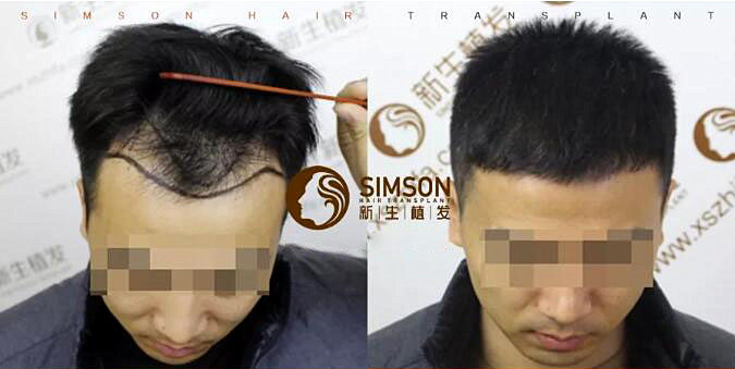 头发秃发植发吗