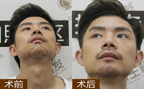 南京美人尖种植是怎样的