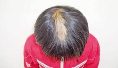 遗传脱发能预防吗