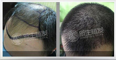 植发有什么后遗症和危害吗