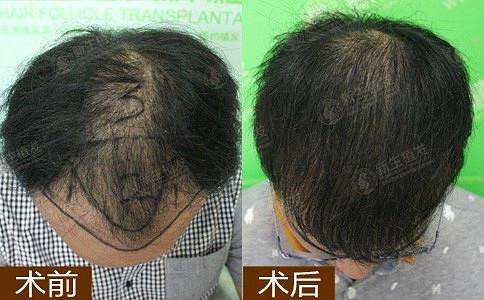 年纪轻轻为什么会脱发？