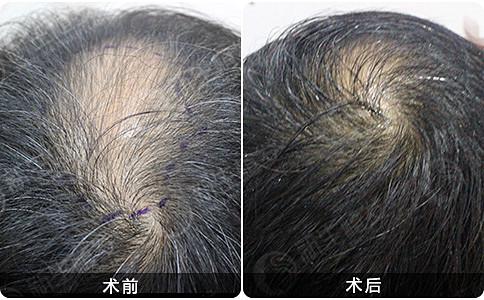 如何预防营养性脱发？