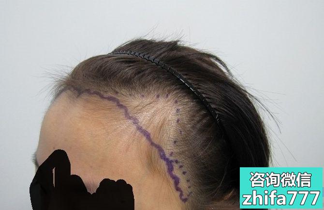 长沙碧莲盛发际线种植越来越漂亮啦