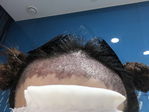 遗传性的脱发怎么破