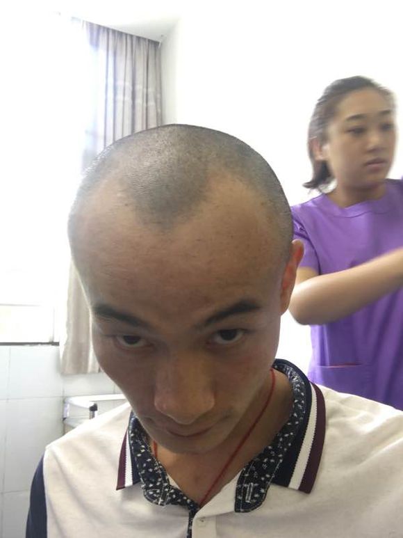 这个脱发问题怎么才能解决
