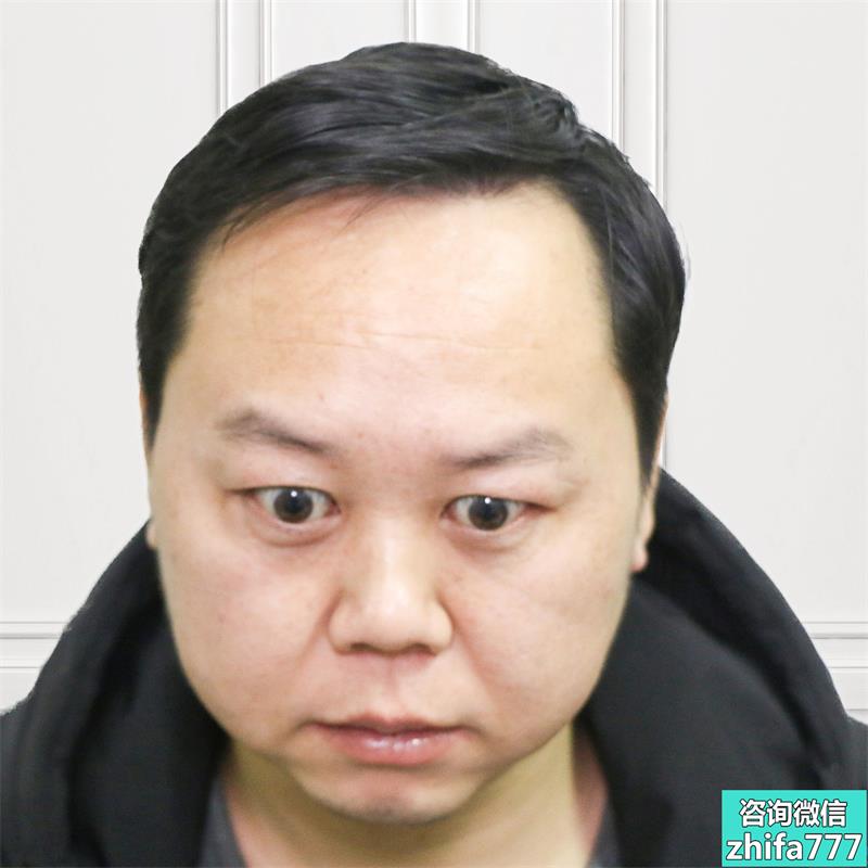 上海新生鬓角种植，术后自然有型