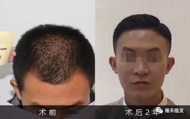成都大学生无痕植发2419单位1年后