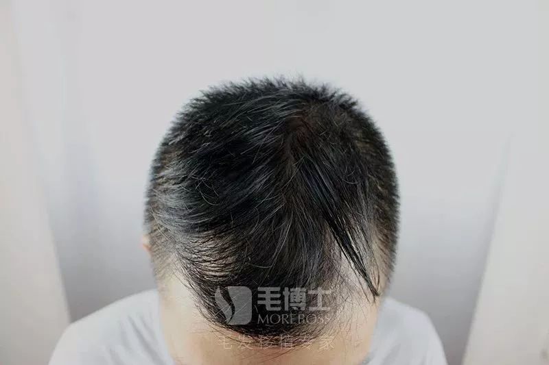 人未老发已荒植发2789单位他再也不慌了！