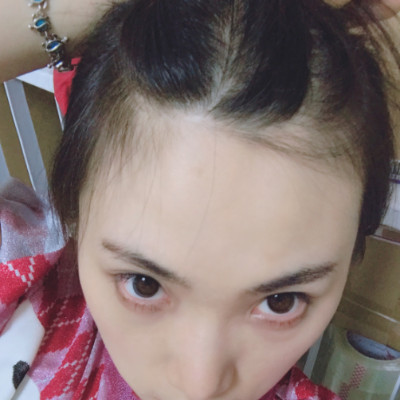 长时间中分导致发缝变宽？做个稀少加密吧，术后效果分享