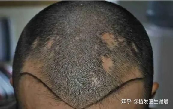 头上有疤痕很多年了，想做疤痕植发，存活率高吗？